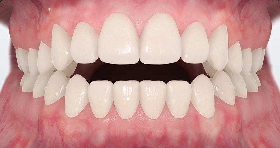 Open-bite