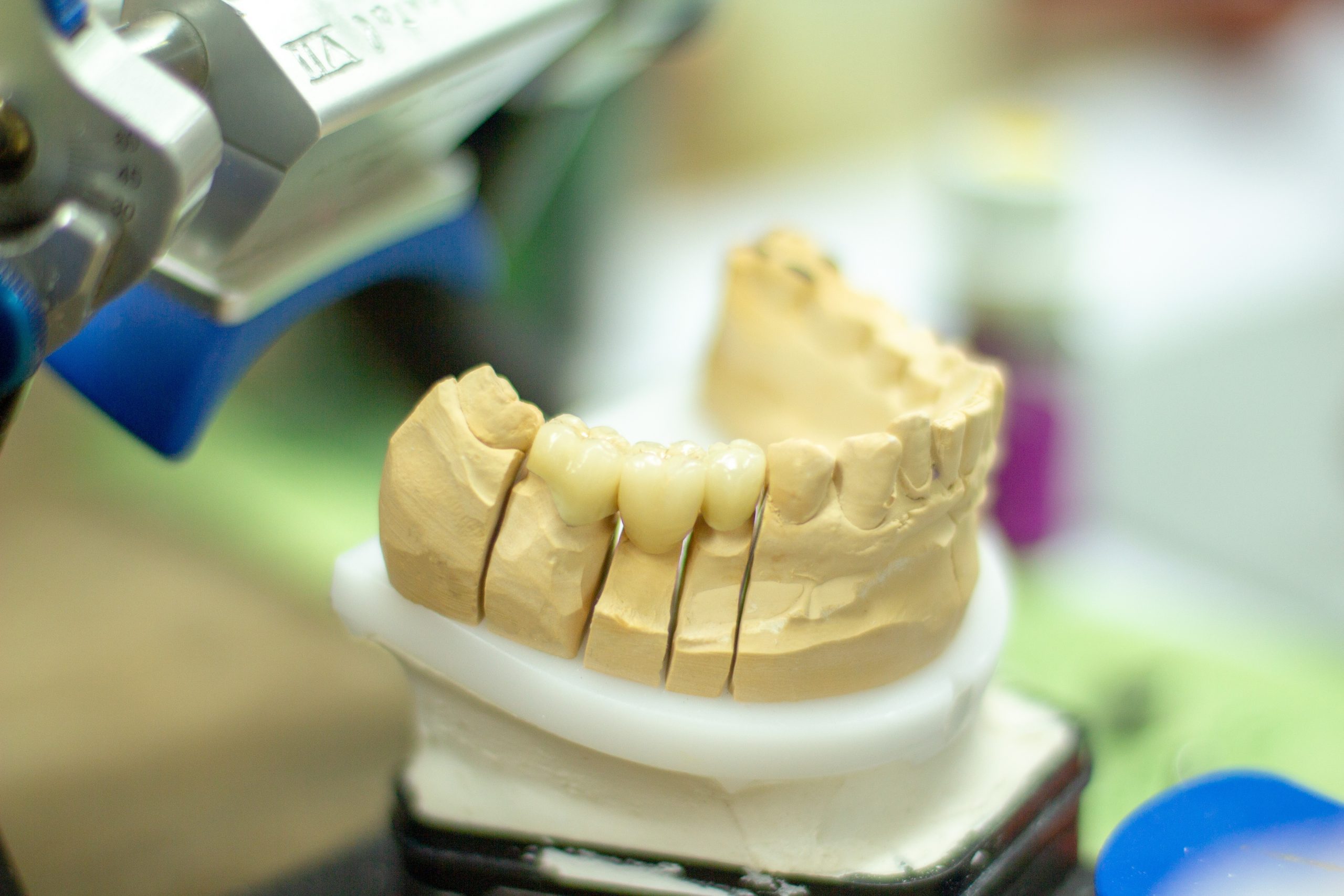 The Benefits Of Computer Guided Dental Implant Surgery Dental Artistry