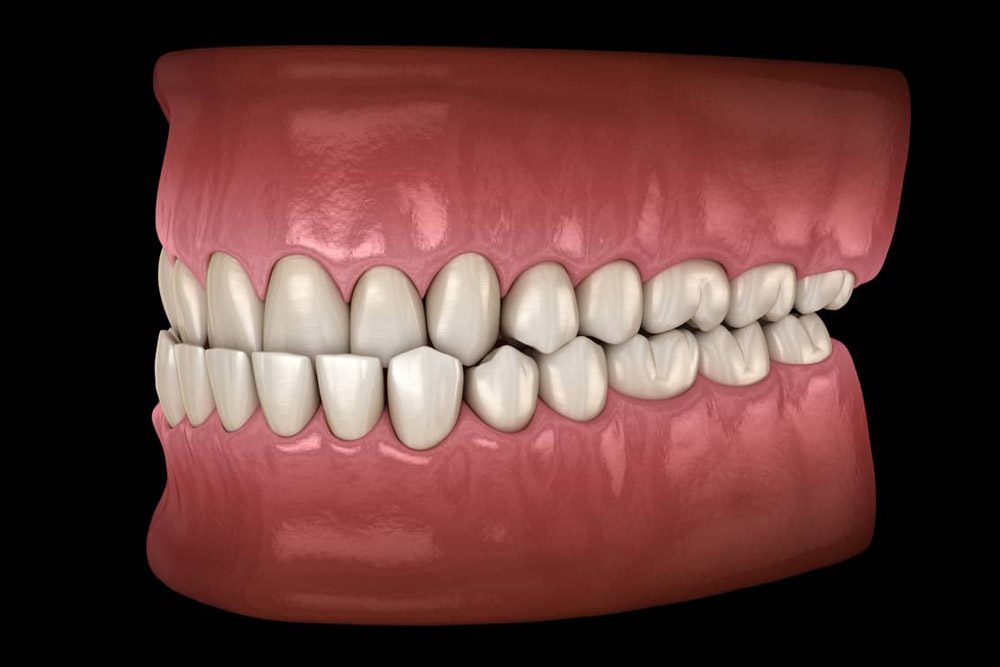 underbite